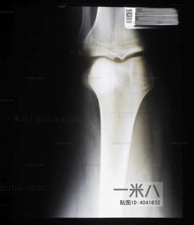 膝关节X射线