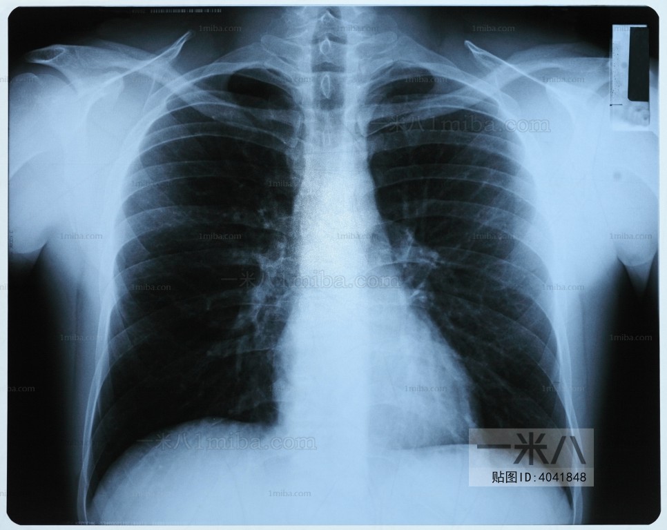 胸部X射线