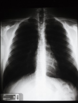 胸部X射线-ID:4041770