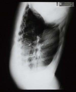 胸部X射线-ID:4041772