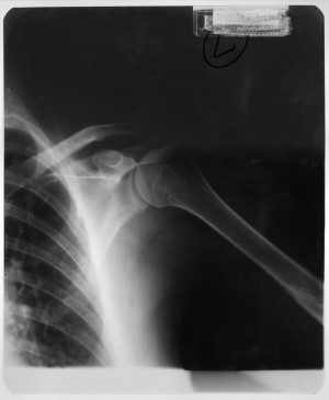 肩X射线-ID:4041778