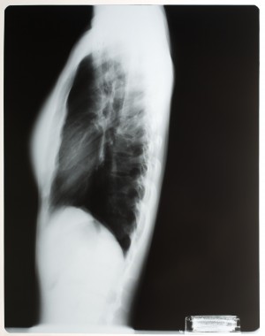 胸部X射线-ID:4041782