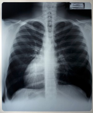 胸部X射线-ID:4041802