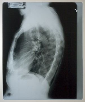 胸部X射线-ID:4041803