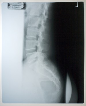 胸部X射线-ID:4041805