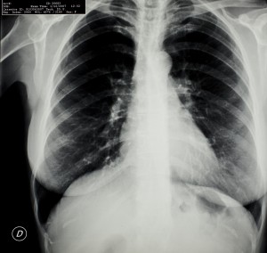 胸部X射线-ID:4041815