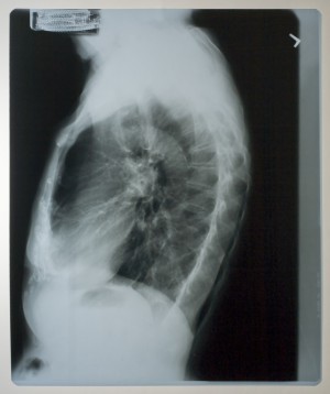 胸部X射线-ID:4041827