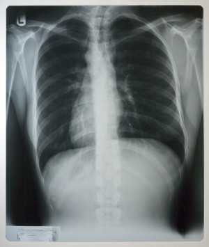 胸部X射线-ID:4041829