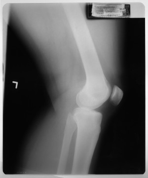 膝关节X射线-ID:4041830