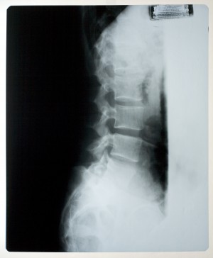 胸部X射线-ID:4041845