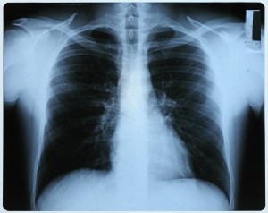 胸部X射线-ID:4041848