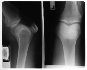 膝关节X射线-ID:4041850